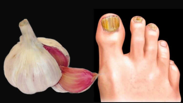 Cette astuce simple élimine le champignon des ongles comme par magie…