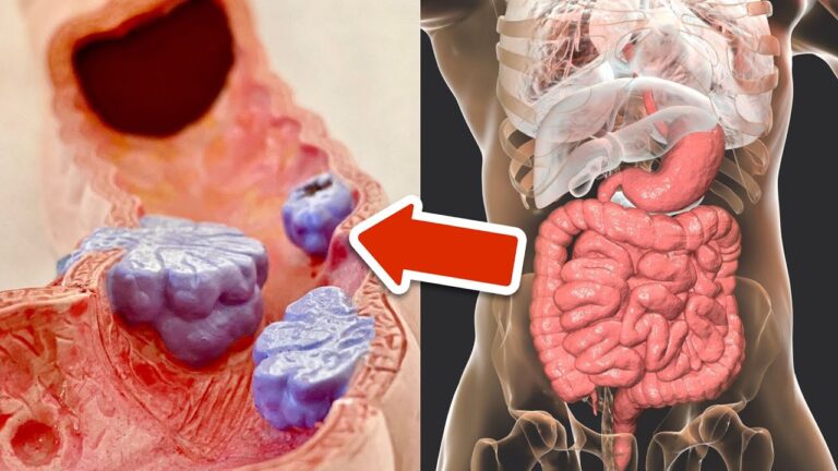 6 conseils essentiels pour réduire votre risque de cancer colorectal dès aujourd&rsquo;hui !