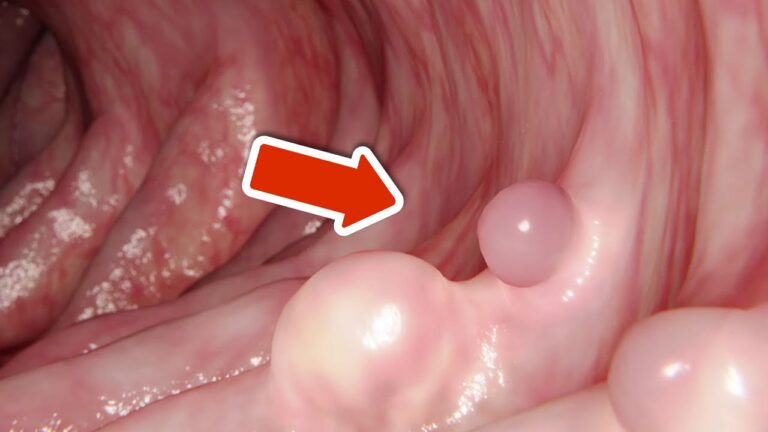 8 signaux de prévention du cancer colorectal à ne jamais ignorer pour ta santé !