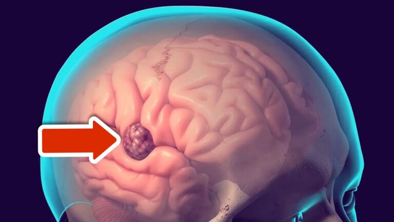 6 signes d’un tumeur cérébrale à ne jamais ignorer pour ta santé !