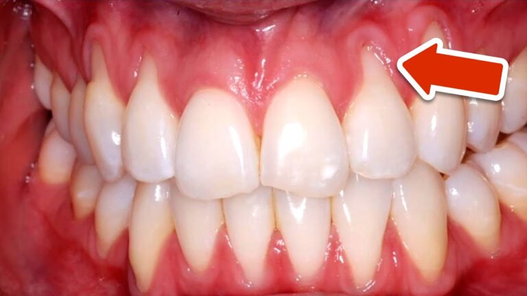 Récupérez votre sourire : 5 astuces simples pour lutter contre le recul des gencives !