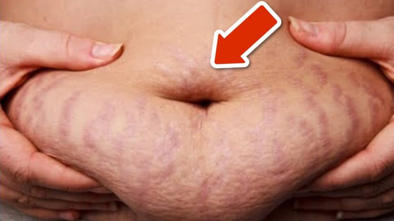 Éliminez 5 astuces simples pour dire adieu aux vergetures efficacement !